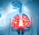 Lung cancer even without smoking Are you making these mistakes at home