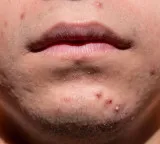 Acne treatment through healthy eating habits and nutrition