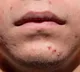Acne treatment through healthy eating habits and nutrition