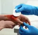 Wounds vanish without stitches IICT new innovation