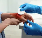 CSIR-IICT to promote surgical adhesive for rapid wound closure