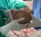 Doctors successfully remove 3 kg stone from bladder