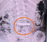 5 year old Chinese girl swallows 50 gram gold bar here is what happened next