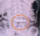 5 year old Chinese girl swallows 50 gram gold bar here is what happened next