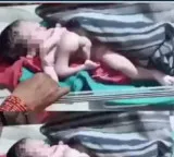 Rare incident in Madhya Pradesh baby born with 4 legs and 4 arms