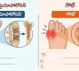 Osteoporosis and Gout are both the same here is the difference