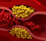 Bad cholesterol reduced by 52 percent with a single dose hopes for new gene therapy