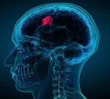 Brain tumor diagnosis game-changer test results in 2 hours instead of 8 weeks