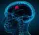 Brain tumor diagnosis game-changer test results in 2 hours instead of 8 weeks
