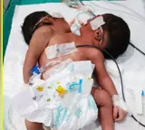 Two headed baby born in Odisha a rare medical case