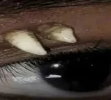 Tooth in eye rare incident in medical history doctors stunned
