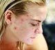 Skin Care Acne and Rashes on Skin Know the Real Causes and Prevention