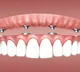 Dental implants cause of stubborn infections revealed by scientists