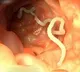 Parasitic worm lives in brain for seventeen years