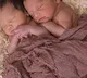Conjoined twins separated at AIIMS after 24hour surgery