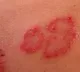 Skin Rashes also a symptom of Coronavirus positive
