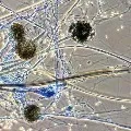 Black Fungus cases raises in Maharashtra