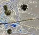 Black Fungus cases raises in Maharashtra