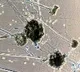 UP registers 73 Black Fungus cases