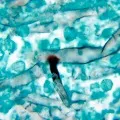 kadapa man died in hyderabad hospital with black fungus