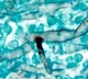 kadapa man died in hyderabad hospital with black fungus