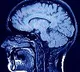 Covid impact on the brain and mind are varied and common