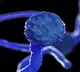 Black Fungus First Patient Spent Above 1 Crore For Treatment