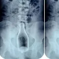 Bottle found in XRay of a drinker
