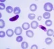 New type of Malaria emerges in Kerala