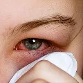 pink eye may be one of the covid symptom