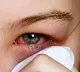 pink eye may be one of the covid symptom