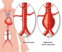 Vascular Diseases: Be Aware and protect yourself and loved ones