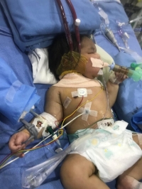 ECMO saves life of a one-day-old baby
