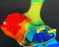 Doctors at KIMS hospitals treat  Covid-19+ve Lady at term pregnancy with abnormal heart Rhythm