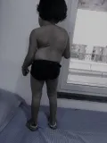 Doctors of KIMS Kondapur save a 6-year old girl from lifelong deformity