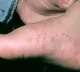 Rashes on feet could be sign of Covid19