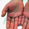 kawasaki disease linked to corona shocks Newyork