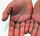 kawasaki disease linked to corona shocks Newyork