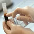 Corona patient recovered after plasma therapy