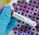 First corona positive case registered in AP